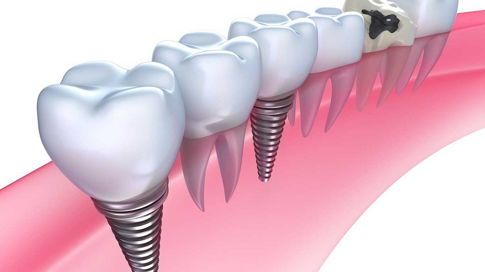 OSSTEM DENTAL IMPLANTS