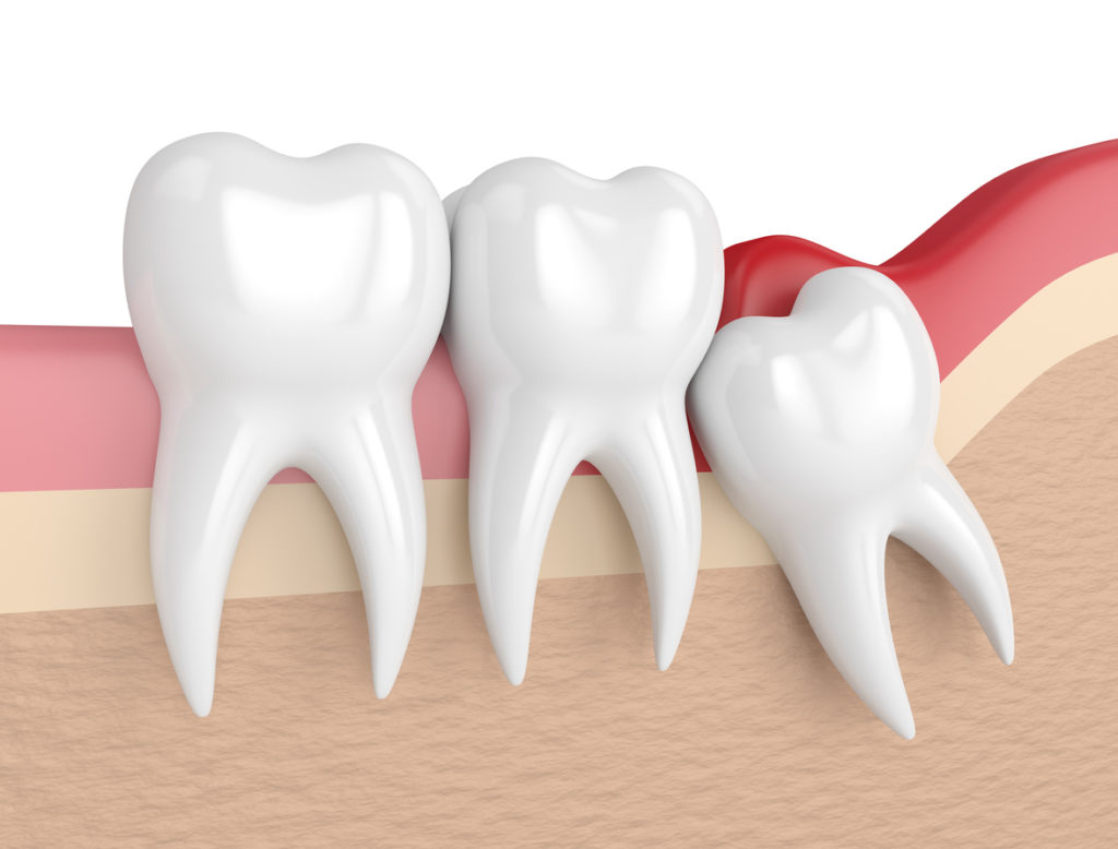 wisdom mesial impaction with pericoronitis